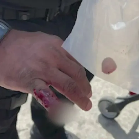 Hand with a finger severed